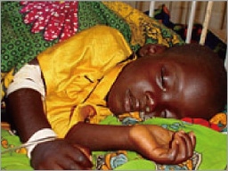 シプリアーノ５歳 重度の栄養不良とマラリアを発症し治療センターで集中治療を受けている。
