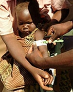 ブレンダちゃん（2歳）はマラウイのチワンバ保健センターに行くまで、1年以上慢性的な栄養不良だった。