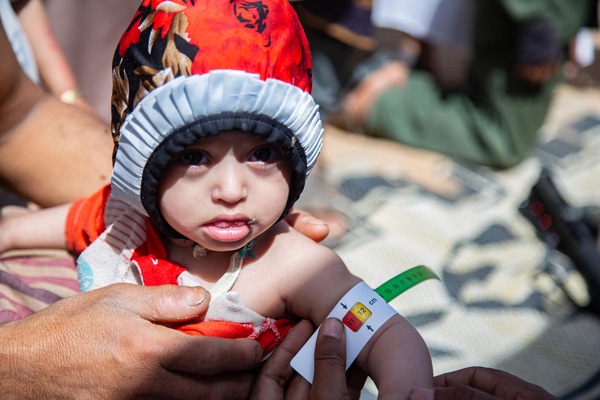 マアリブにある国内避難民キャンプで、上腕計測メジャーを使って栄養不良の検査を受ける1歳のアルワちゃん。(イエメン、2020年3月撮影)