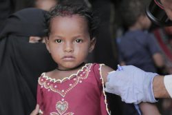 ハッジャ県の農村部で、栄養不良の検査を受ける2歳のホダちゃん。(2020年3月撮影)