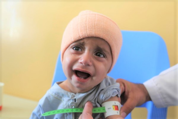 カンダハールの総合保健センターで、上腕計測メジャーを使った検査で「赤」が示され、重度の急性栄養不良と診断された1歳のシャリフラちゃん。(アフガニスタン、2022年1月撮影)