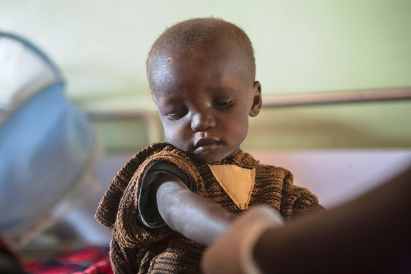 すぐに食べられる栄養治療食(RUTF)と栄養価の高い治療用ミルク(F-75)のおかげで、重度な栄養不良から症状が回復しつつある赤ちゃん。(ウガンダ、2022年2月撮影)