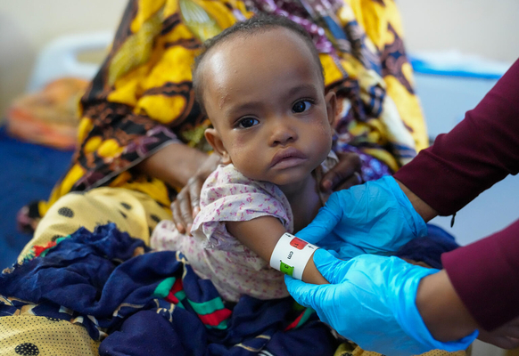 モガディシュの病院で、上腕計測メジャーを使った検査で「赤」が示され、重度の栄養不良と診断された1歳のモカダスちゃん。(ソマリア、2022年5月25日撮影)