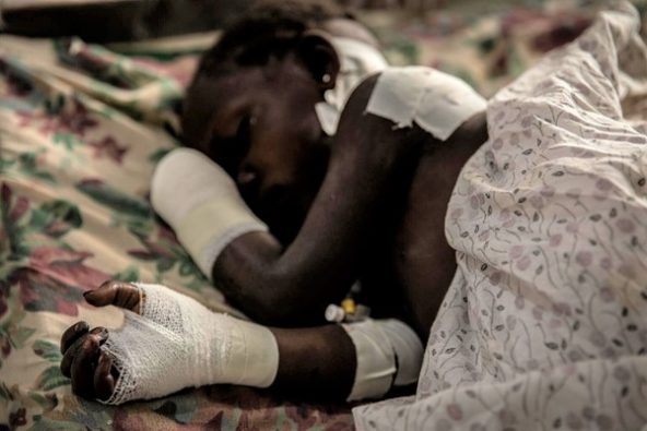 東部のイトゥリ州ブニアの病院のベッドで横になる女の子。ナタで手を切り落とされ、治療を受けた。保護者がおらず身元も分からない。(コンゴ民主共和国、2022年2月撮影)