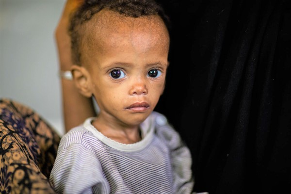 アファール州の病院で、重度の栄養不良の治療を受ける1歳のアリちゃん。(エチオピア、2022年5月撮影)