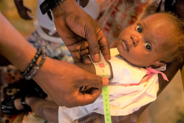 上腕計測メジャーで「赤」が示され、重度の栄養不良と診断された。シテ・ソレイユの5人に1人の子どもは急性栄養不良になっている。(ハイチ、2022年5月撮影)
