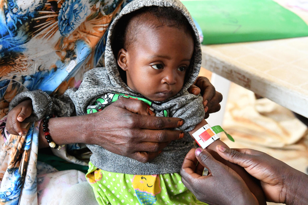 首都ンジャメナの最東端にあるユニセフが支援する栄養センターで、上腕計測メジャーを使った栄養検査により「赤」が示された重度の栄養不良の子ども。(チャド、2022年1月撮影)