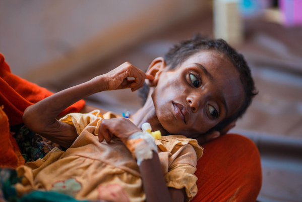 栄養不良で病院の栄養集中治療室に入院し、ユニセフの支援による治療を受ける2歳のラキアトウちゃん。(マリ、2022年8月撮影)