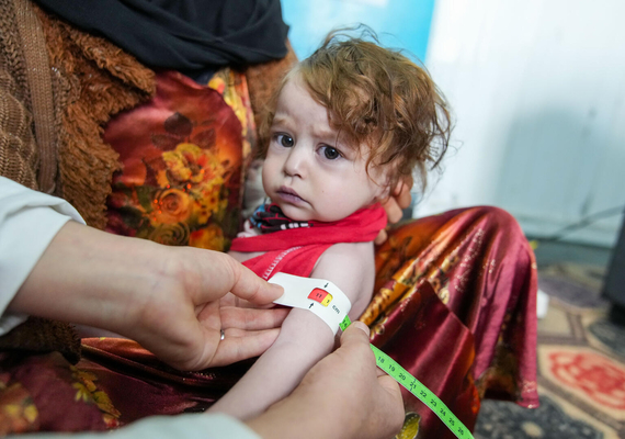 州立病院の小児科病棟で、上腕計測メジャーを使った栄養検査で重度の急性栄養不良と診断された1歳のレハナちゃん。(アフガニスタン、2023年3月1日撮影)