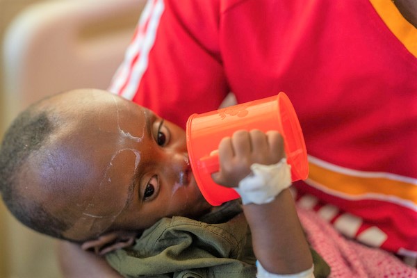 干ばつの影響でモガディシュまで避難してきた1歳のアブディマリクちゃん。下痢と嘔吐の症状があり、何も食べておらず栄養不良状態だったため入院し治療を受け、今は回復しつつある。(ソマリア、2023年2月撮影)