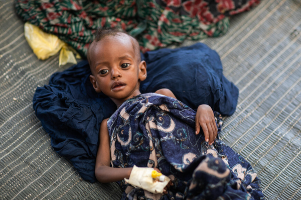 アファール州の仮設の治療施設で、重度の栄養不良と診断されたアリエムちゃん。アファール州は干ばつや紛争の影響で、食料不足が深刻化している。(エチオピア、2022年5月撮影)