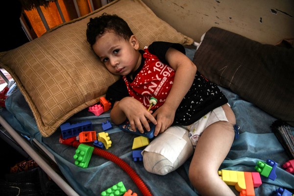 中部のヌセイラトの自宅が爆撃され、脚を負傷した3歳のアフマドちゃん。合併症を引き起こしナセル病院へ移送されたが、医薬品が十分になく、脚を切断することとなった。(ガザ地区、2023年12月6日撮影)