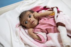 サアダの総合病院で、栄養治療を受ける生後7カ月のリナちゃん。(イエメン、2024年2月18日撮影)