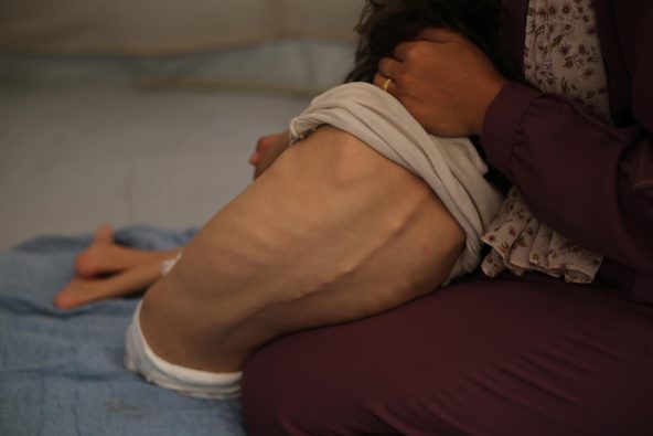 ガザ中部にあるブレイジ難民キャンプで暮らす、重度の栄養不良に苦しむ7歳の女の子(パレスチナ、2025年7月28日撮影)