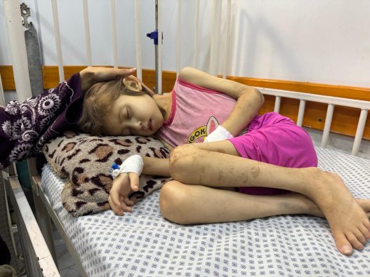 ガザ市内の病院で、栄養不良と診断されて治療を受けている9歳のヤナさん（パレスチナ、2025年8月25日撮影）
