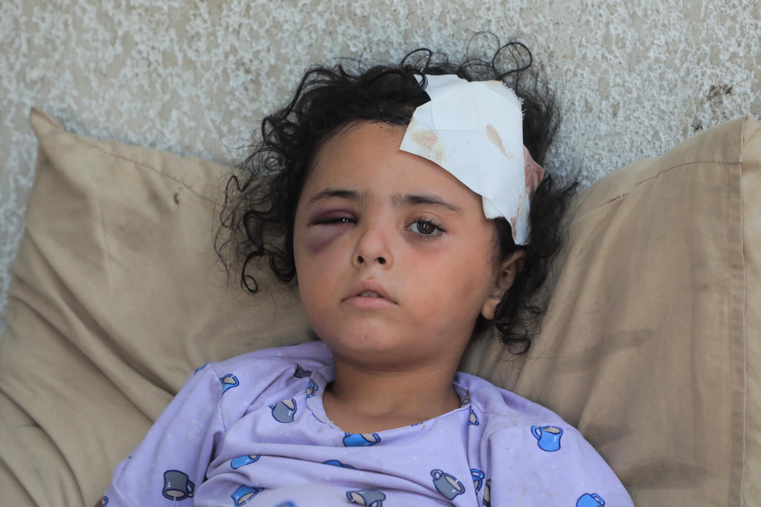 ガザ市の避難民キャンプで、友達と遊んでいた時に近くで爆撃があり、その破片でけがを負った6歳のマリアムさん。頭蓋骨を骨折し、脳に血腫ができた娘を見て、父親は「私たちが逃げられる場所はもう空しかない」と話す（パレスチナ、2025年9月16日撮影）