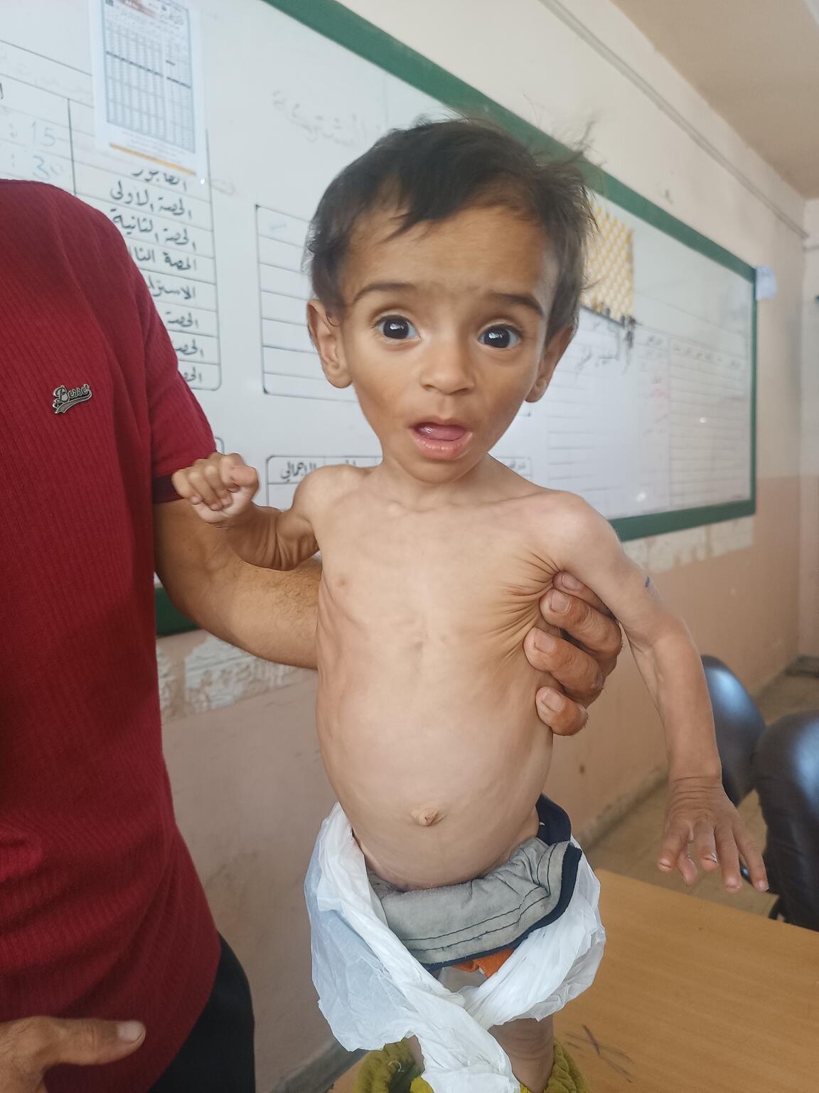 重度の急性栄養不良の治療を受ける前のオデイちゃん。痩せ細り、ほとんど反応できない状態だった（パレスチナ、2025年7月14日撮影）