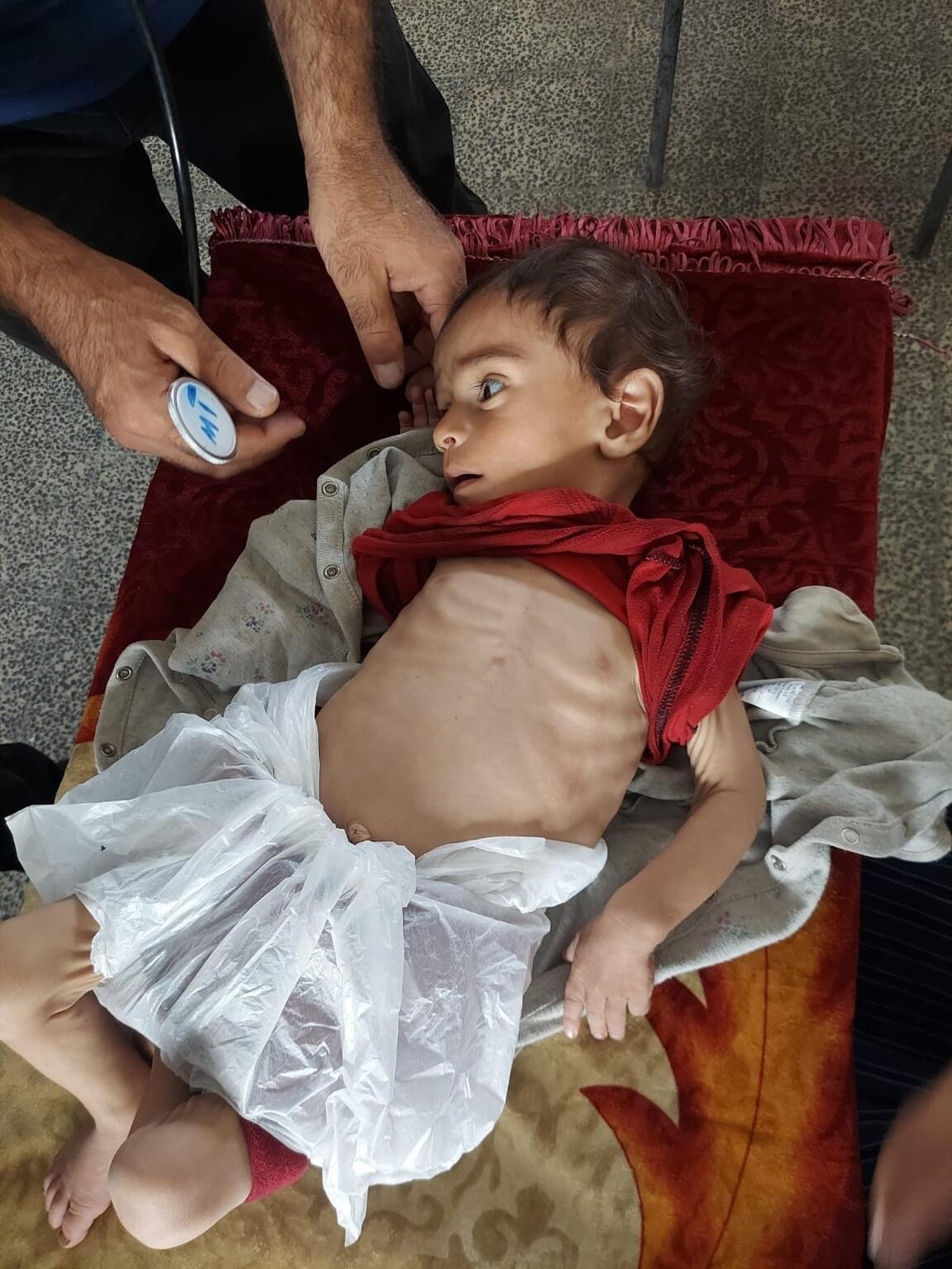 移動診療所の医療スタッフから、栄養状態の診察を受けるオデイちゃん（パレスチナ、2025年7月14日撮影）