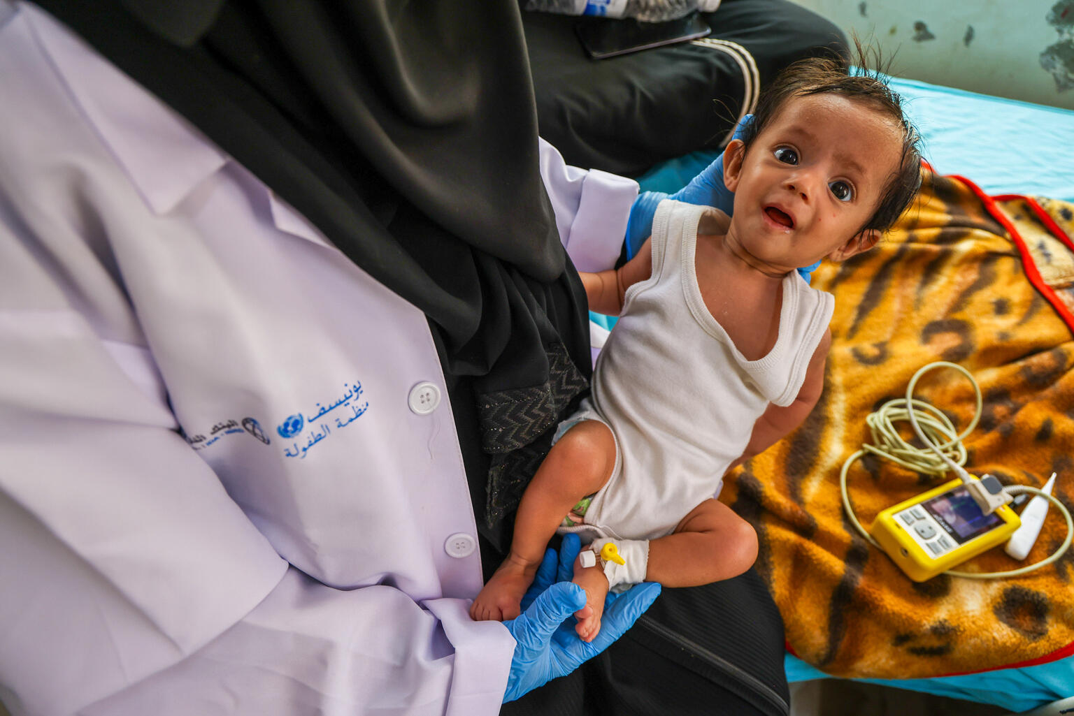 重度の急性栄養不良と診断されていた生後9カ月のラヤン・アハメドちゃん。ユニセフが提供する治療用ミルクなど、必要な栄養治療を受け、快方に向かっている（イエメン、2025年7月22日撮影）