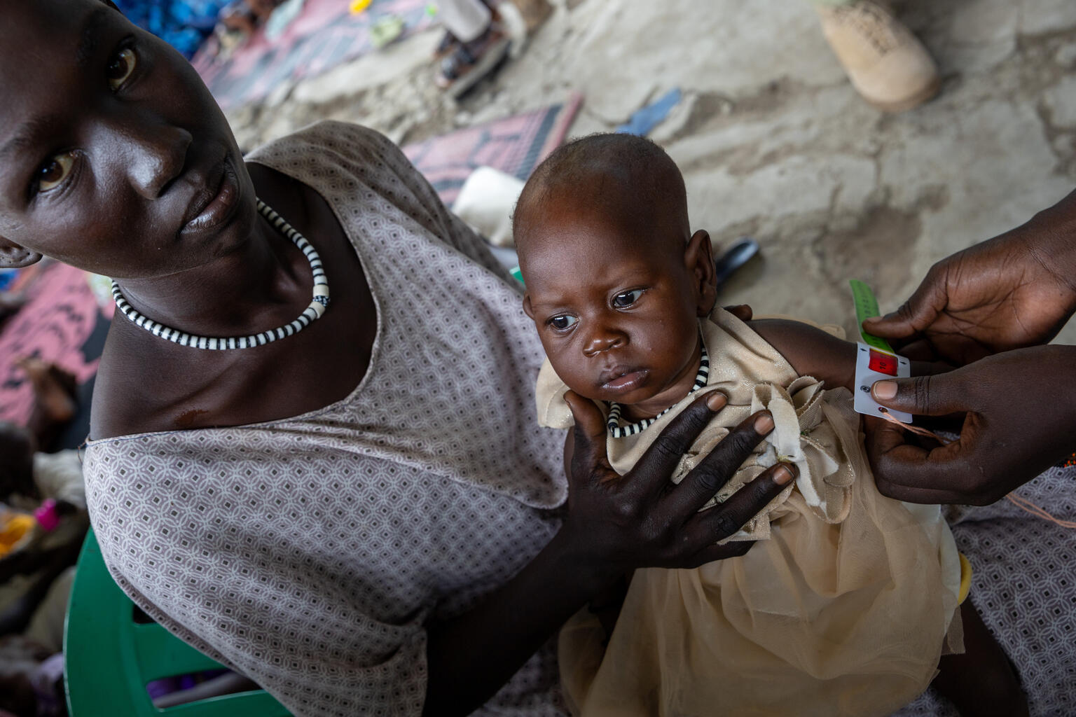 ジョングレイ州ボルのユニセフが支援する保健センターで、栄養不良の検査を受ける生後6カ月のアコムちゃん。上腕計測メジャーの赤色は、重度の栄養不良状態を示す（南スーダン、2025年10月21日撮影）※本信の内容と直接の関係はありません