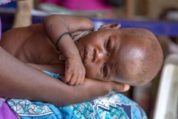 ユニセフが支援する保健センターで、治療を受けている、重度の急性栄養不良の男の子。（ナイジェリア・ボルノ州の避難民キャンプ）※本文との直接の関係はありません。