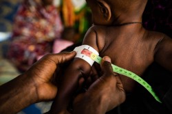 栄養不良の診察の様子。