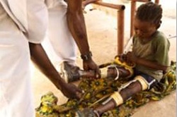 ポリオでまひが現れた足に、歩くための補助具をつける子ども。