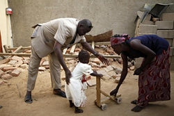 ポリオに感染し、足に麻痺が残った2歳半の女の子。（チャド）