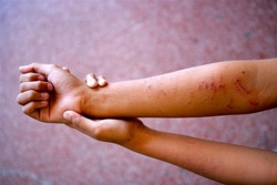 母親から受けた暴力の傷を見せる17歳の女の子。（フィリピン）
