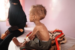 イエメンの首都サヌアにある病院で治療を受ける重度の急性栄養不良に陥った1歳半の赤ちゃん。