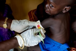 ジュバの病院で診察を受ける南スーダンの子ども。栄養不良と診断された。
